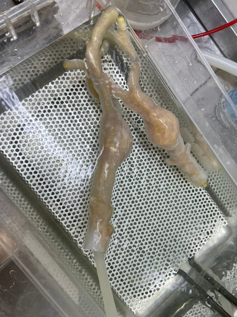 Silicone esophagus & trachea model for surgical planning
